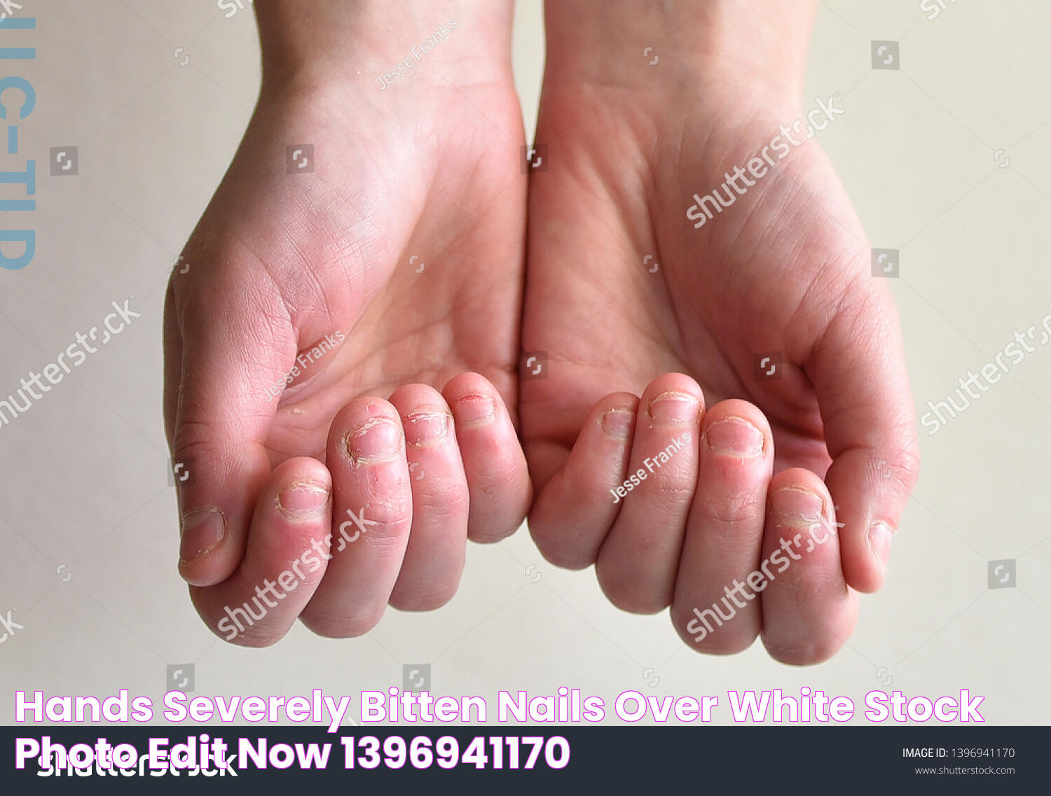 Hands Severely Bitten Nails Over White Stock Photo (Edit Now) 1396941170